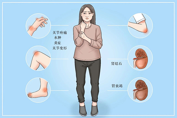 痛风盯上年轻人 竟然跟你每天喝的水有关？